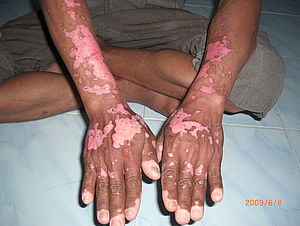 Hautkrankheit auf den Unterarmen und Handrücken eines Arbeiters